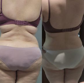 Antes e depois de paciente da Dra. Brendha